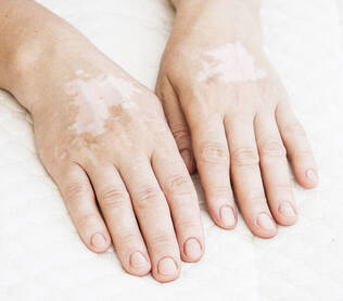 Vitiligo affected parts on a female hand