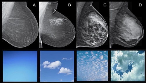 Breast density analogy