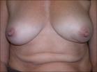 Photo of 56 year old breast patient