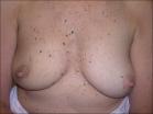 Photo of 59 year old breast patient