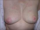 Photo of 45 year old breast patient