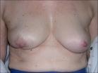 Photo of 50 year old breast patient