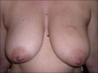 Photo of 60 year old breast patient