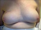 Photo of 64 year old breast patient