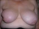 Photo of 65 year old breast patient