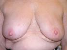 Photo of 70 year old breast patient