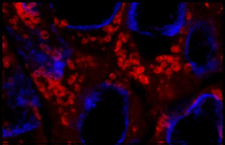 Breast tumor cells