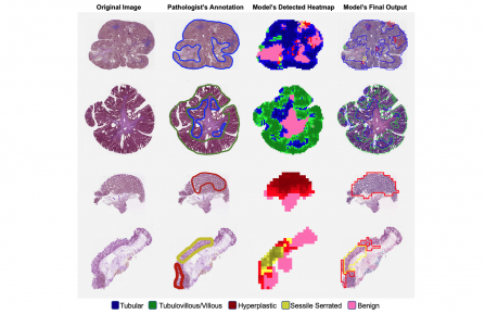 colorectal polyp mapping
