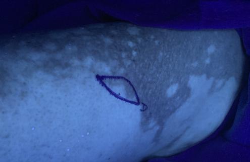 Vitiligo skin biopsy site